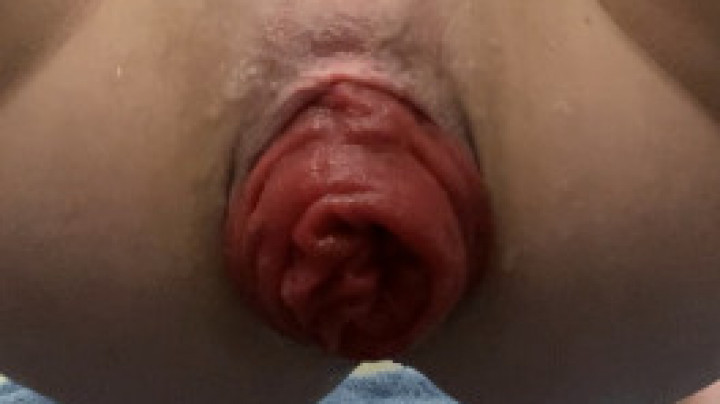 Teen pushes out huge anal prolapse