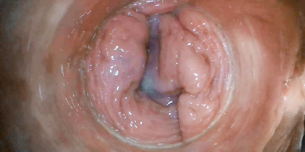 Raw endoscopic video